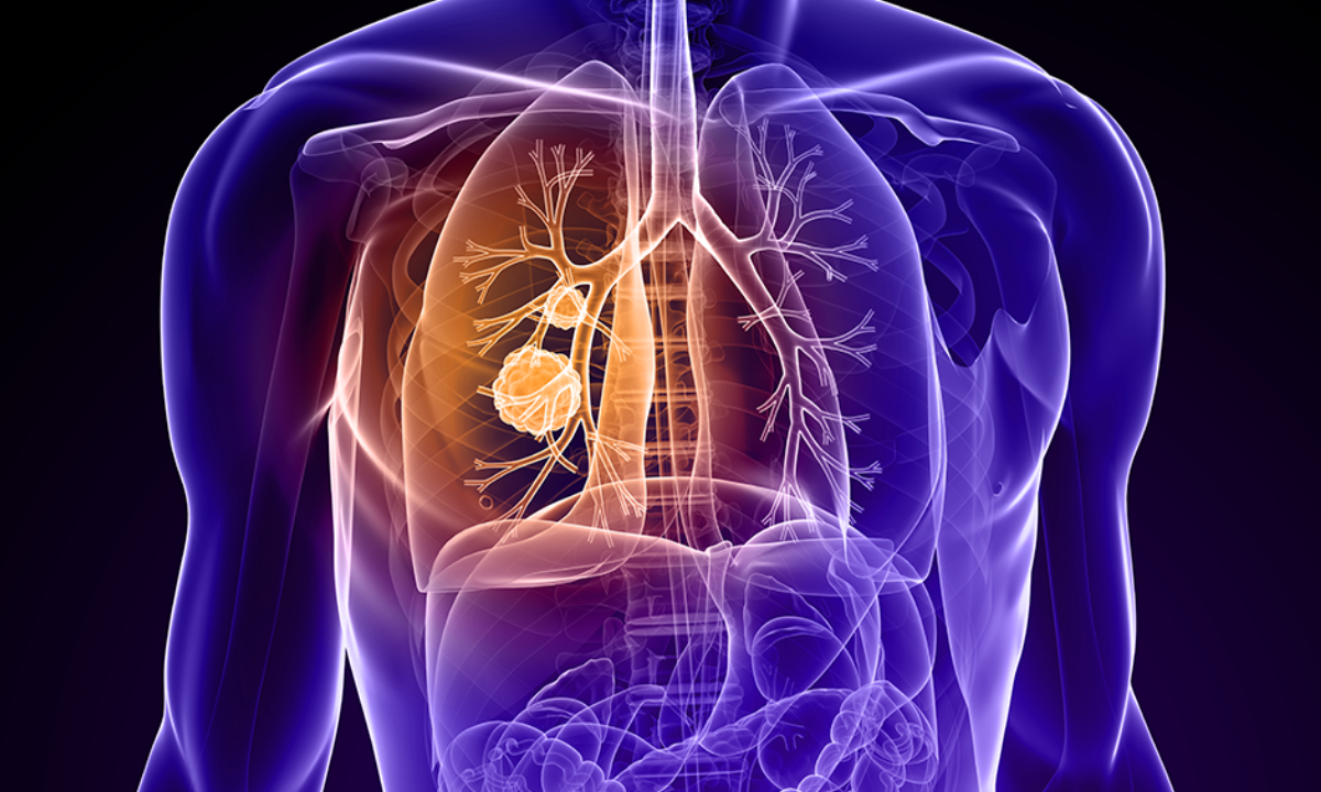 Lung Cancer Treatment in Chennai