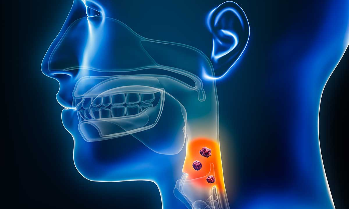 10 Signs You Might Have Throat Cancer  
