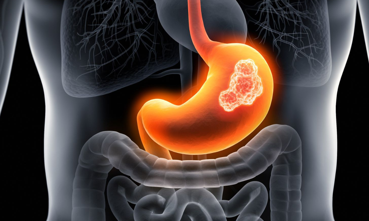 Early Warning Signs of Stomach Cancer 